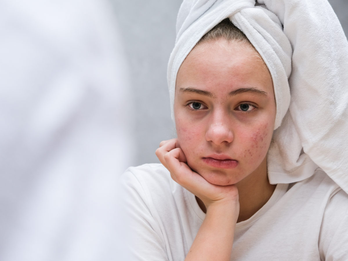 Girl having skin woes