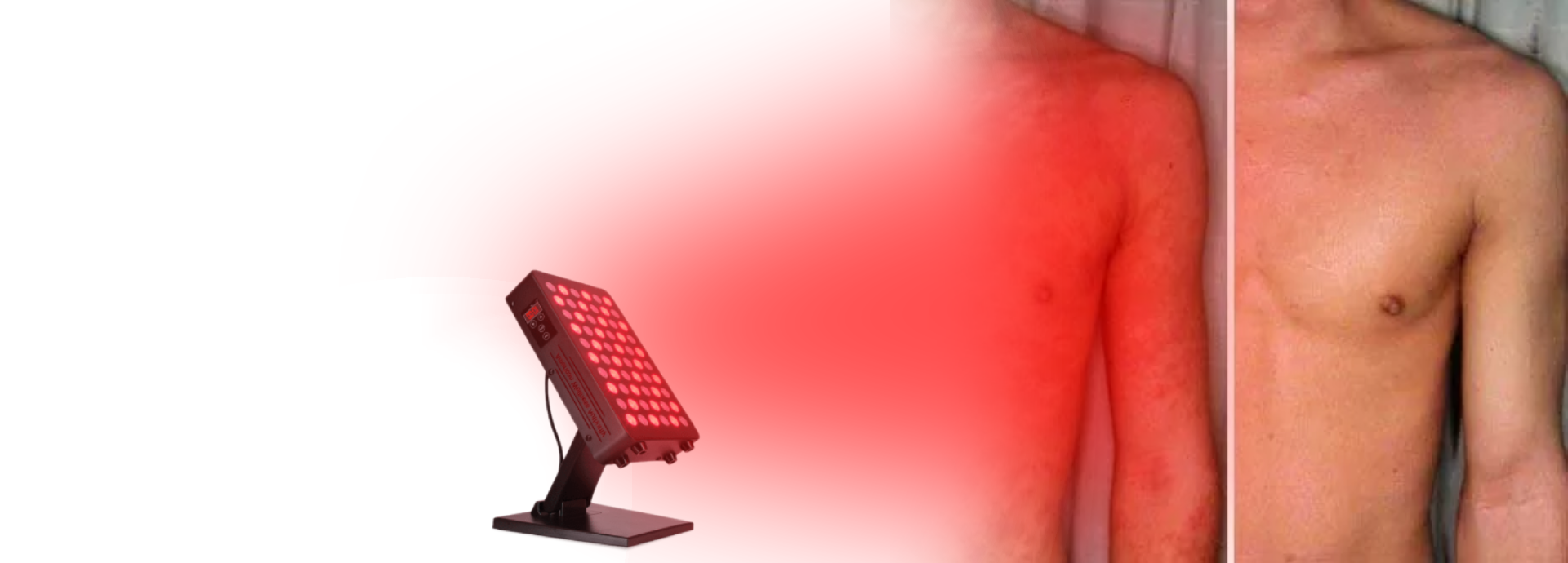 Red Light Therapy Panel for Eczema Treatment